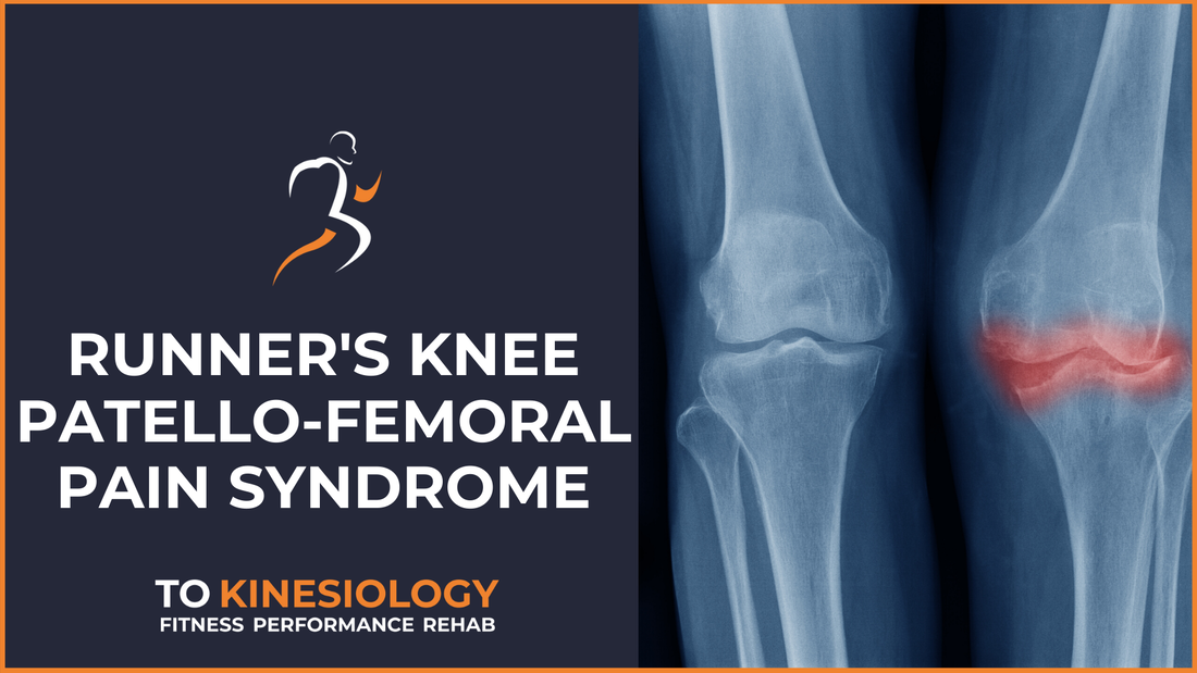runners knee patellofemoral pain syndrome